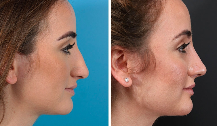 what is rhinoplasty surgery