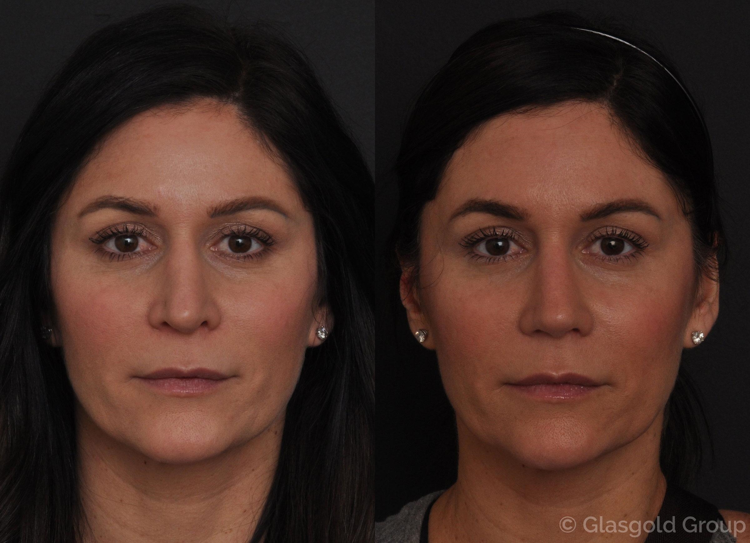 what is rhinoplasty surgery