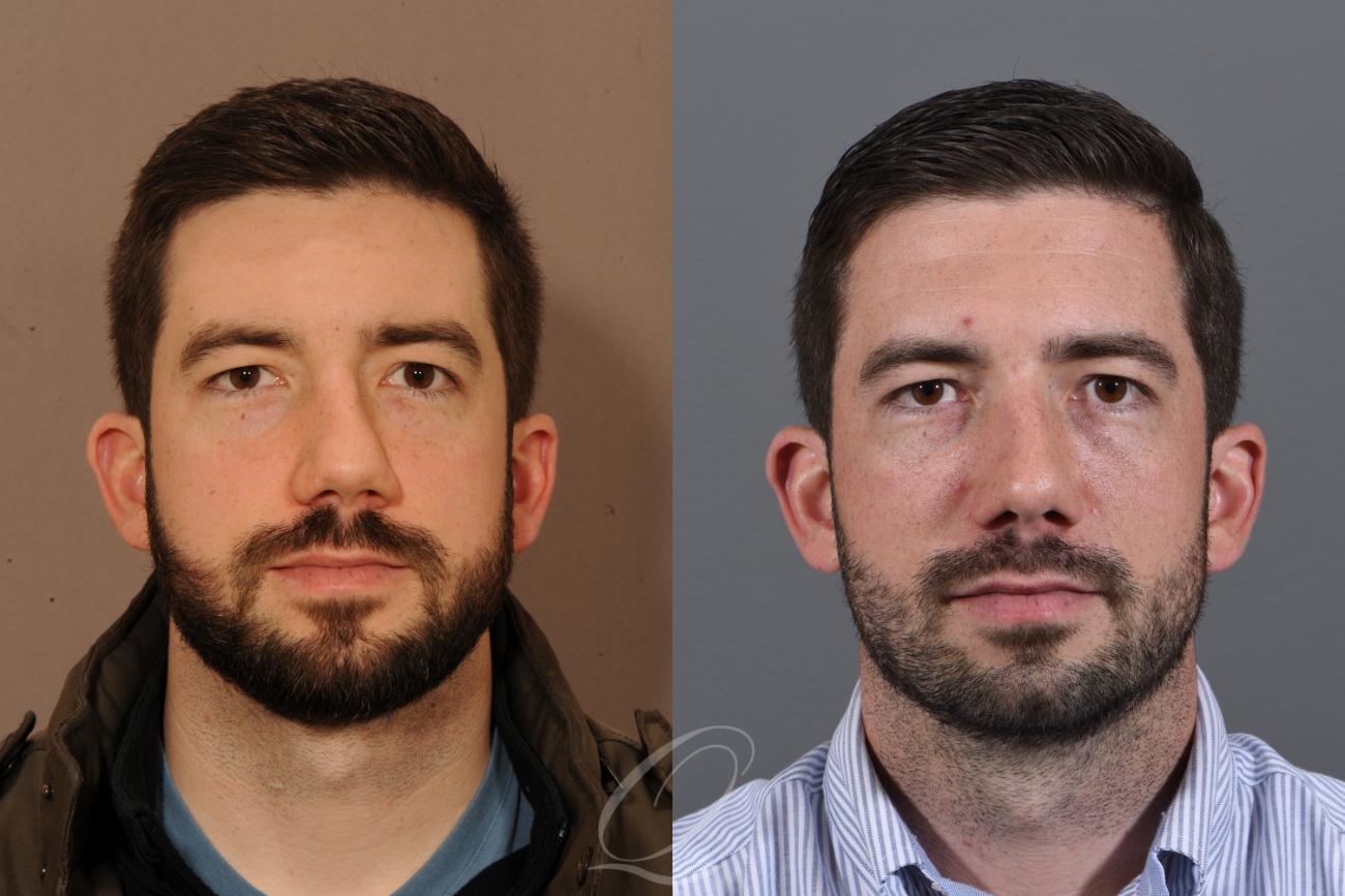 what is rhinoplasty surgery